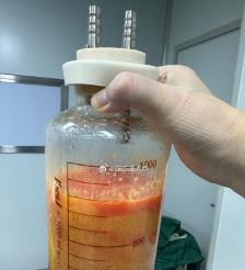 中山水动力吸脂手术要做多久？
